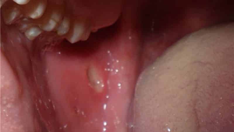 прикус щеки изнутри фото