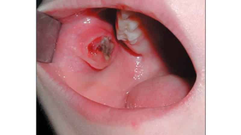 прикус щеки изнутри почему