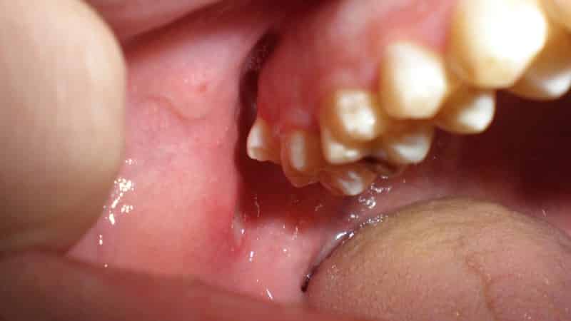 прикусила щеку изнутри как лечить