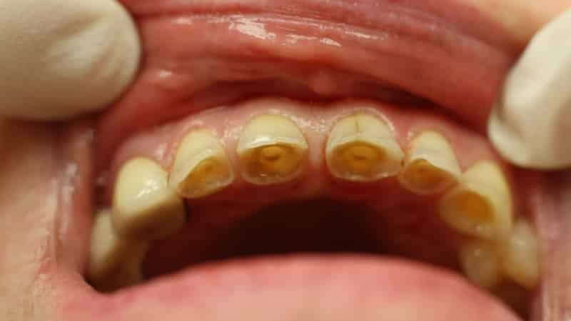 патологическая стираемость зубов фото