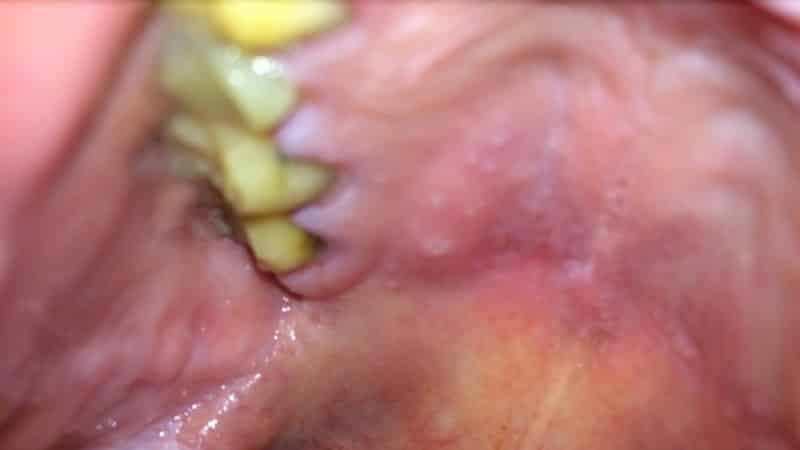 появилась шишка на небе во рту причины