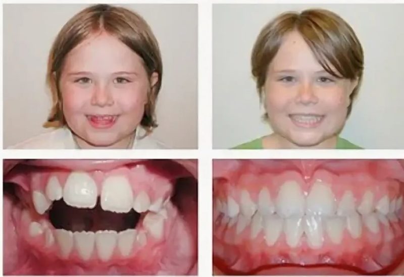 Исправление открытого прикуса у детей и взрослых