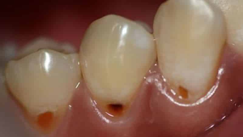 прикорневой кариес фото лечение причины что делать