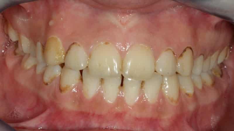 пришеечный кариес лечение