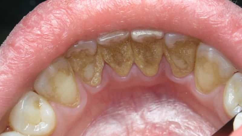 какие продукты полезны для зубов