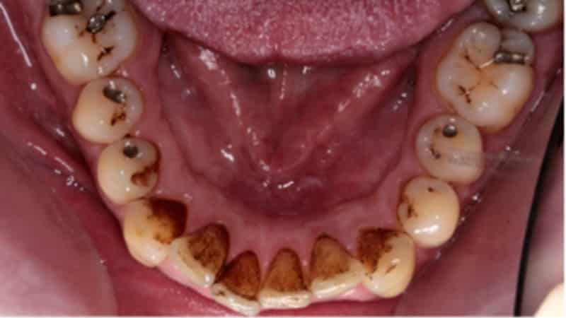 продукты вредные для зубов
