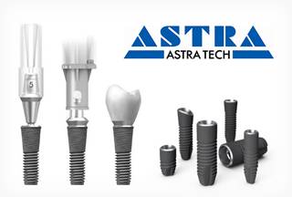 Зубные имплантаты Астра Тек и высокая квалификация наших врачей – ваша идеальная улыбка на долгие годы