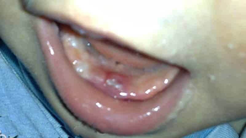 Изменение оттенка десны при прорезывании зубов