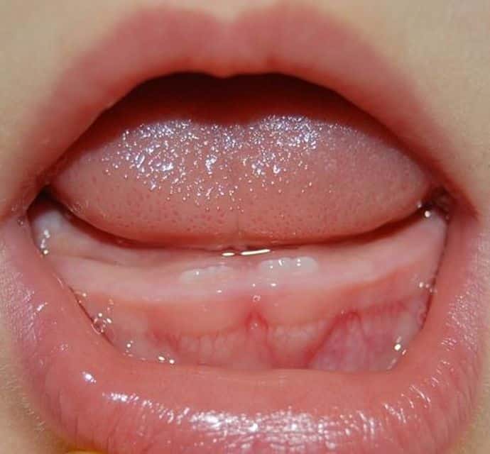 Прорезывание первых зубов у младенцев