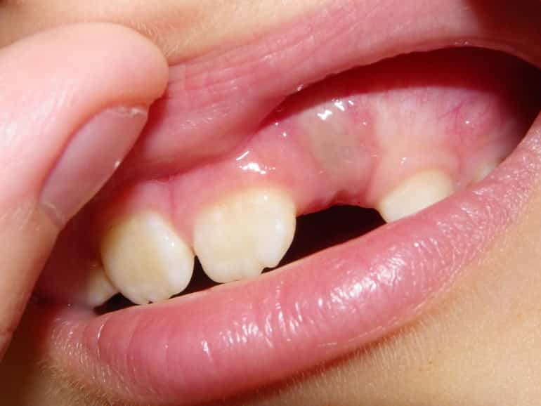 Симптомы прорезывания зубов