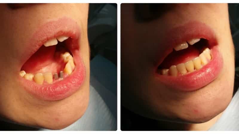 протезирование на имплантах при полном отсутствии зубов