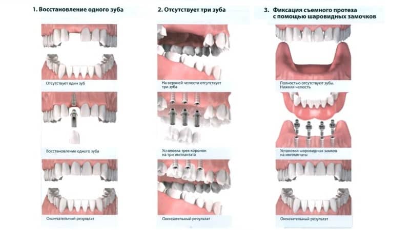 импланты зубов за и против