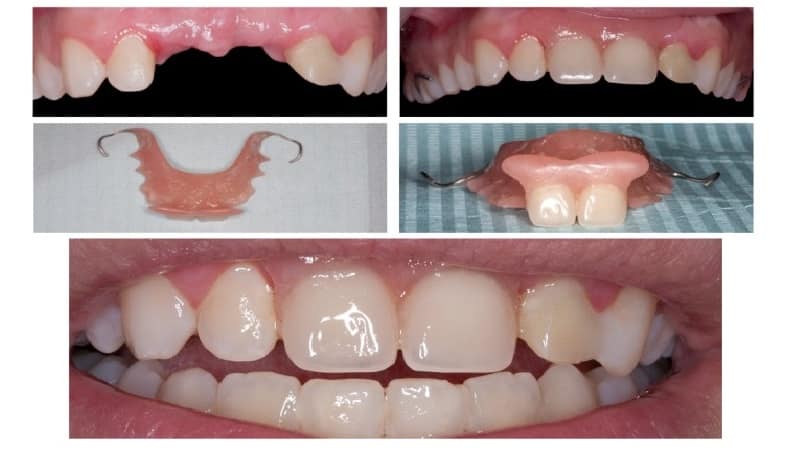 протезирование передних зубов фото до и после