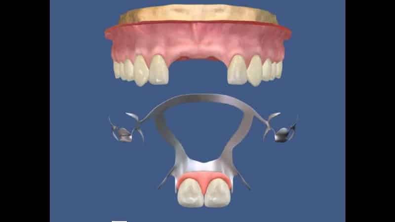 протезирование передних верхних зубов фото