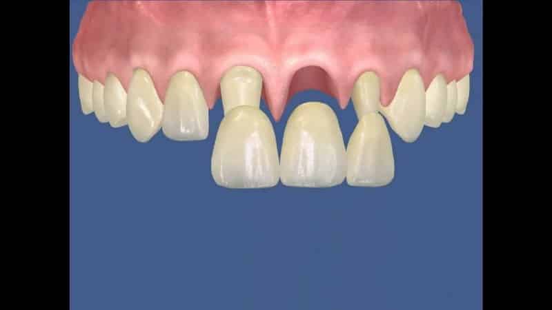 протезирование передних нижних зубов