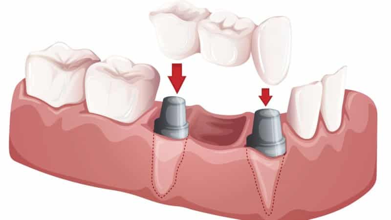 протезирование зубов без обточки