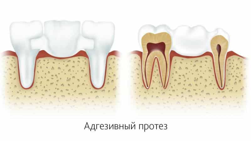протезирование одного зуба без обточки соседних зубов
