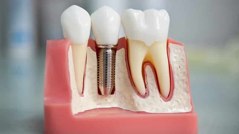 противопоказания для имплантации зубов