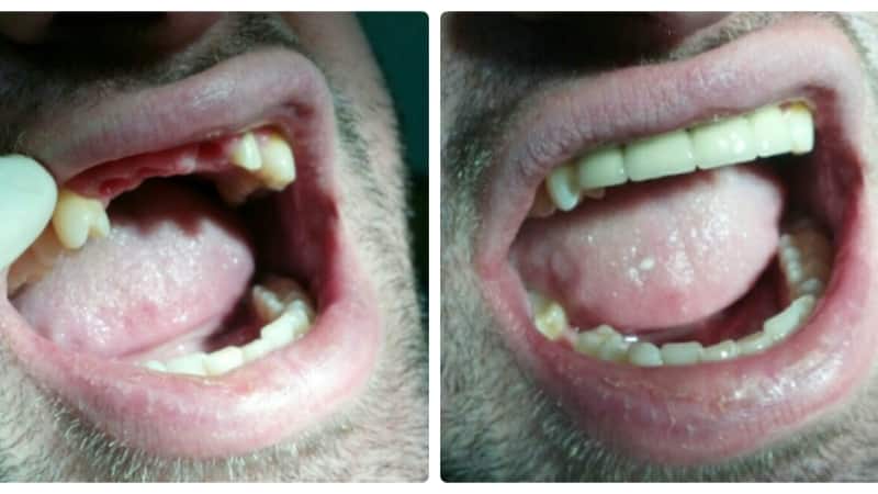 зубные импланты противопоказания