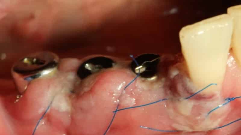 показания к имплантации зубов