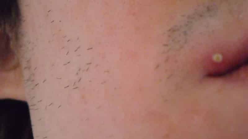 пупырышки на губах