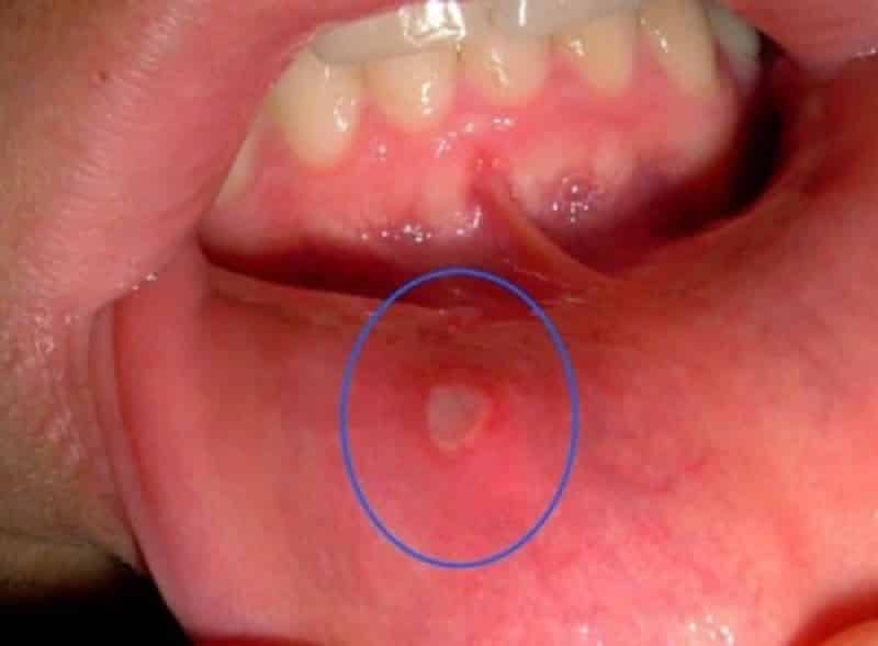 выскочил твердый пузырь во рту на небе что это
