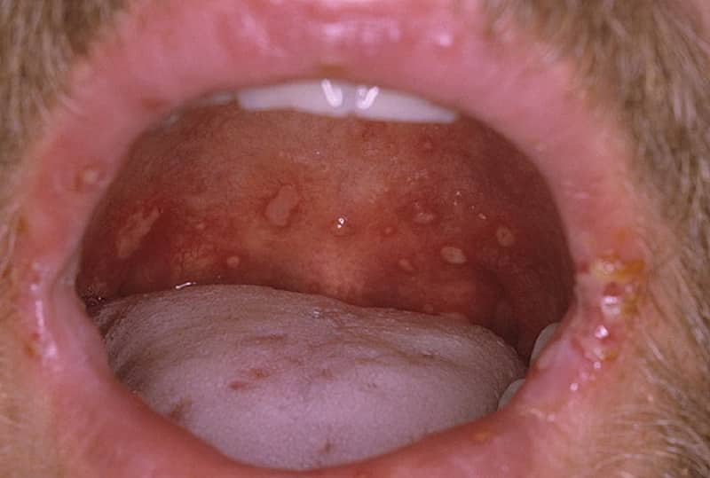 волдыри на небе во рту