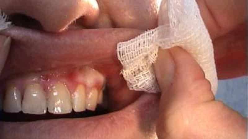 рак десны симптомы фото