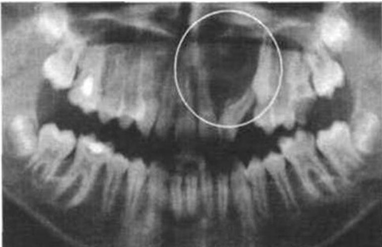 Бывает ли рак зуба и каковы его симптомы