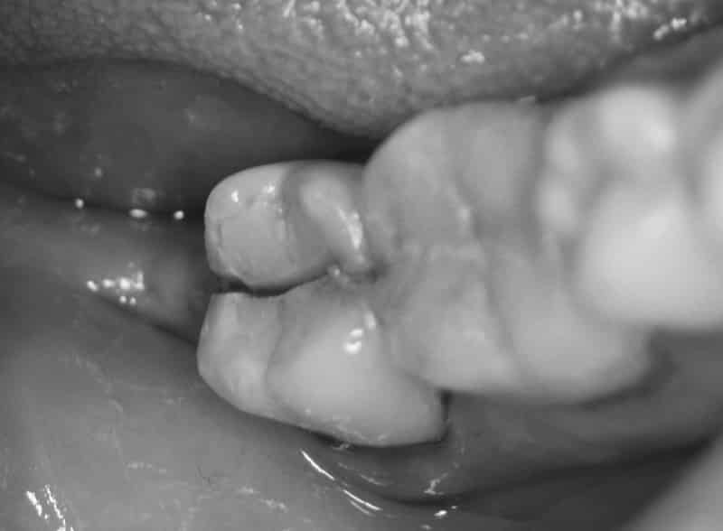 раскололся зуб пополам, что делать