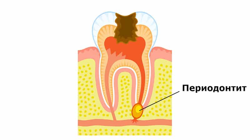Надулась десна над зубом