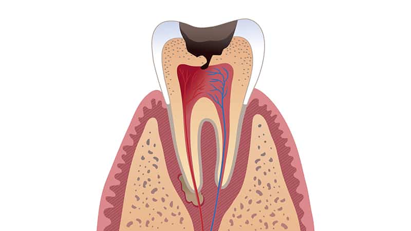 Опухла десна под зубом