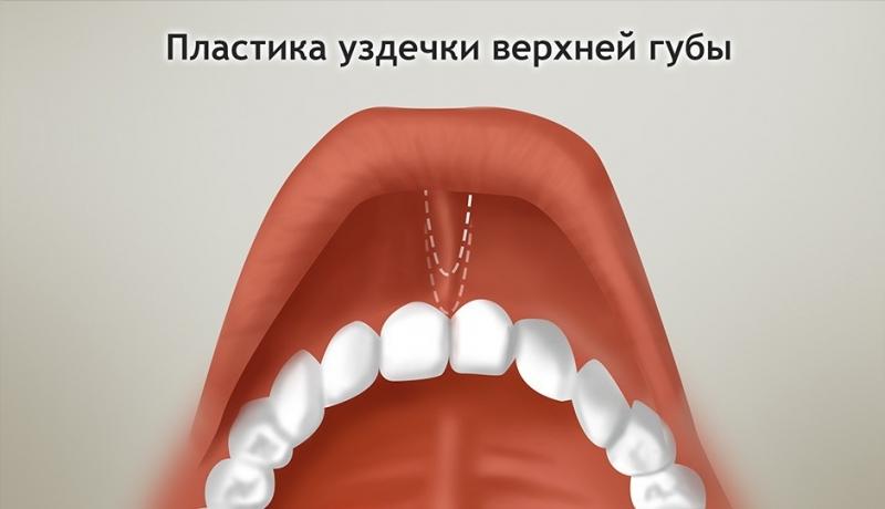 Френулопластика один из методов наряду с френулотомией и френоктомией