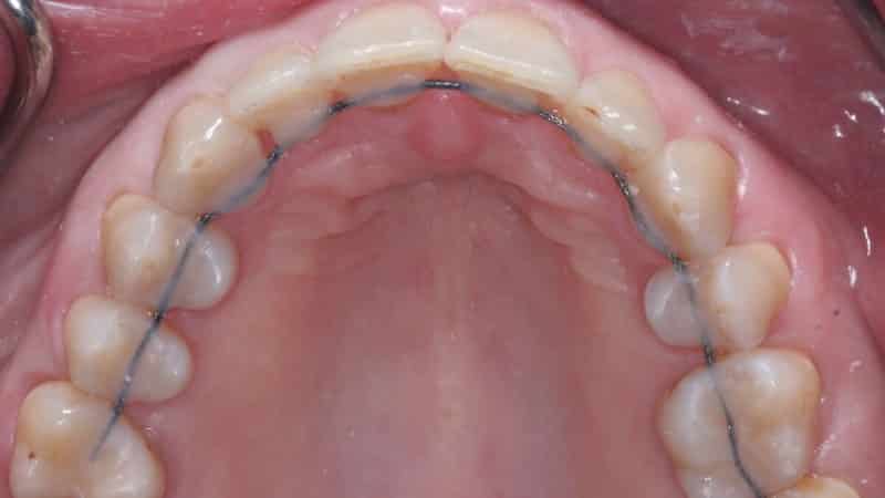 ретейнер после брекетов фото