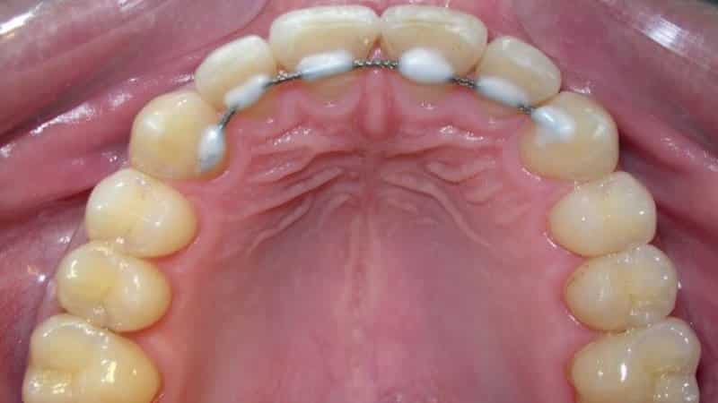 сколько нужно носить ретейнеры после брекетов