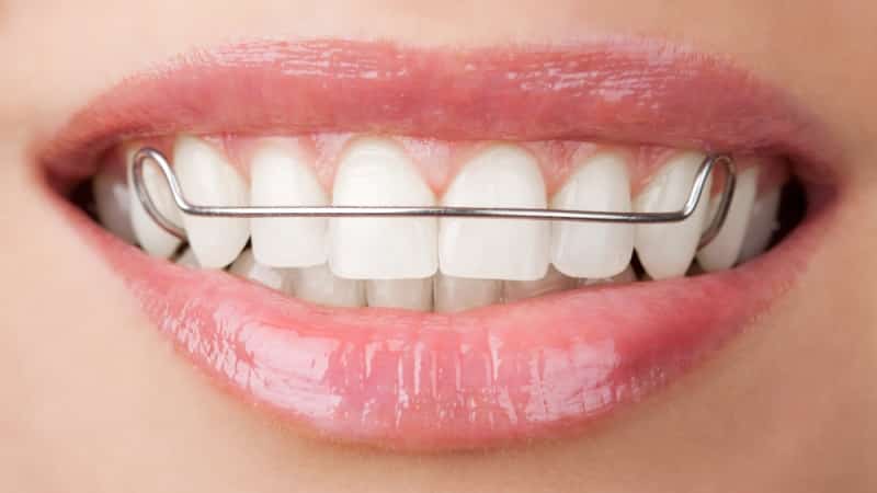 что носят после брекетов