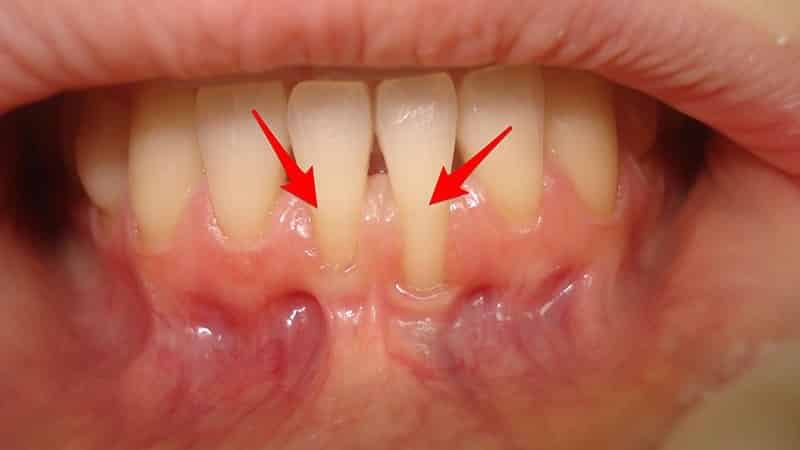 устранение рецессии десны на имплантате