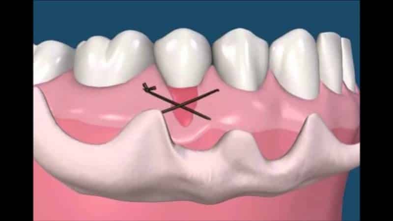 лечение рецессии десны фото