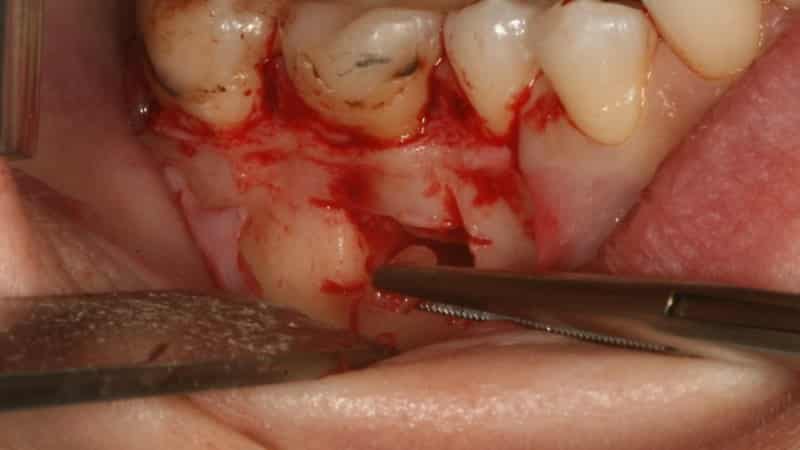 резекция зуба что это такое