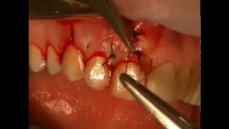 резекция корня зуба
