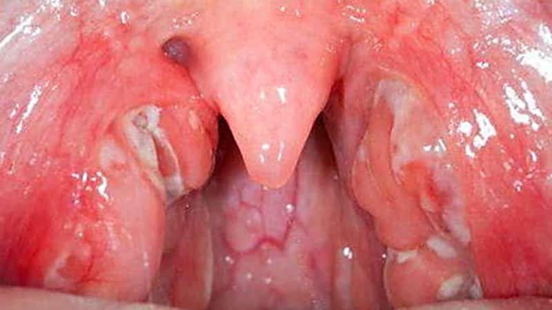 санация миндалин что это такое