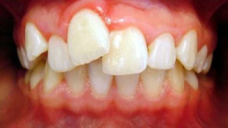 сапфировые брекеты фото до и после