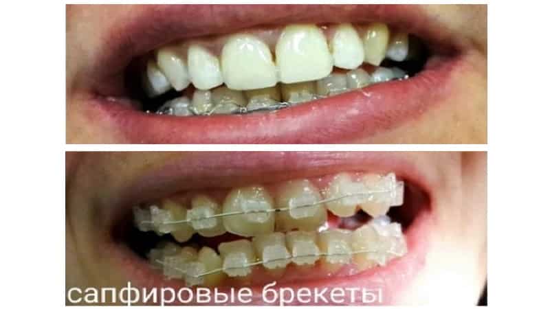 сапфировые брекеты стоимость