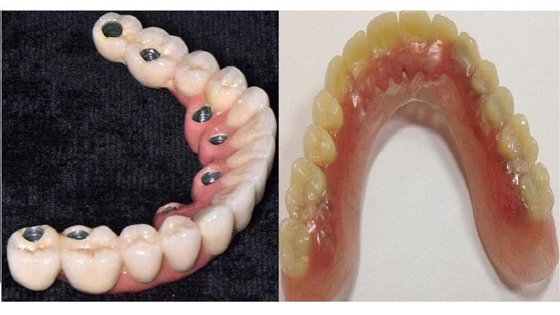 частичный съемный протез на верхнюю челюсть фото