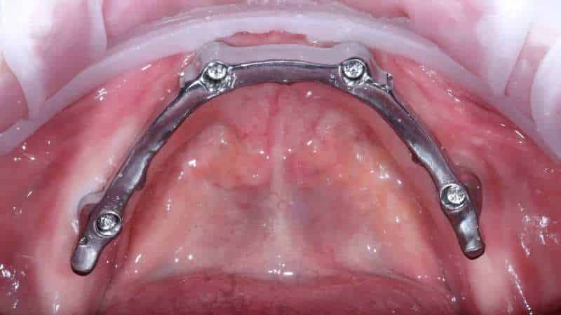 какие бывают съемные зубные протезы на верхнюю челюсть