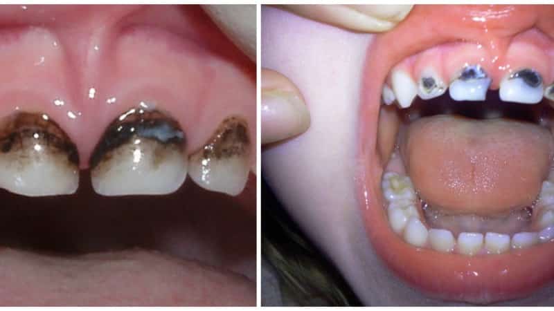 посеребрение зубов детям