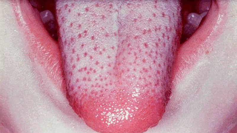 Серый налет на языке