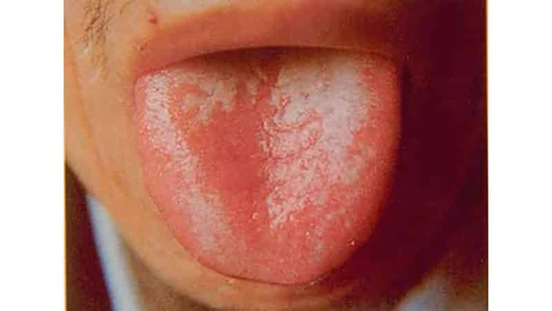 Серый налет на языке