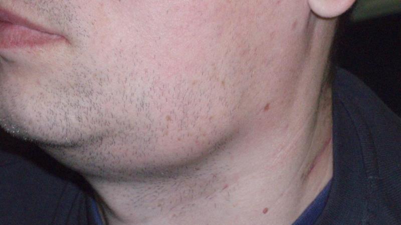 Воспаление подчелюстных лимфоузлов