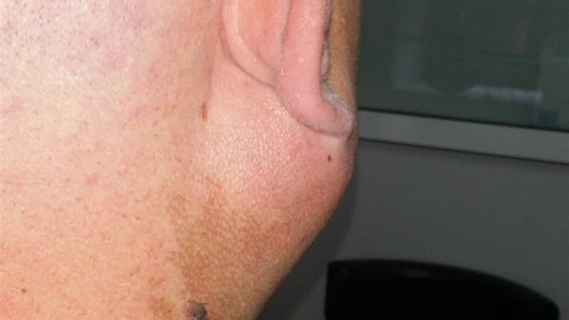 шишка под нижней челюстью справа